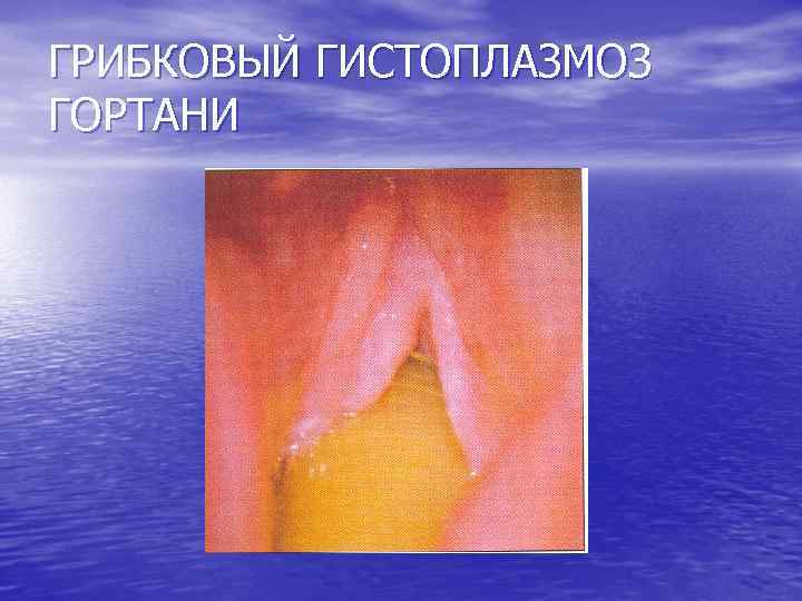 ГРИБКОВЫЙ ГИСТОПЛАЗМОЗ ГОРТАНИ 