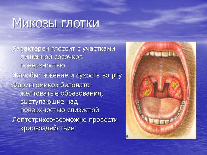 Микозы глотки Характерен глоссит с участками лишенной сосочков поверхностью Жалобы: жжение и сухость во