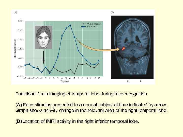 Functional brain imaging of temporal lobe during face recognition. (A) Face stimulus presented to