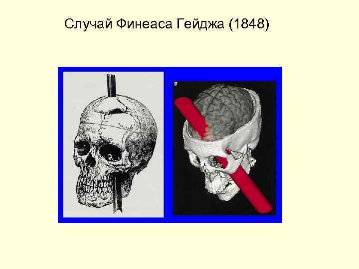 Случай Финеаса Гейджа (1848) 