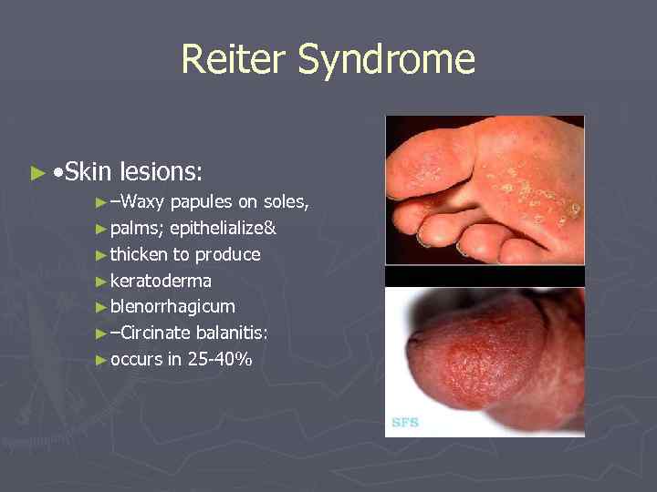 Reiter Syndrome ► • Skin lesions: ► –Waxy papules on soles, ► palms; epithelialize&