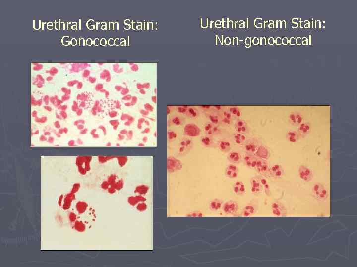 Urethral Gram Stain: Gonococcal Urethral Gram Stain: Non-gonococcal 