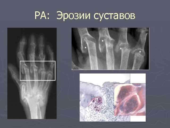РА: Эрозии суставов 