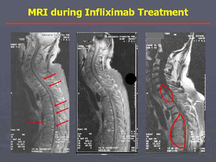 MRI during Infliximab Treatment 0 неделя 12 неделя 54 неделя 