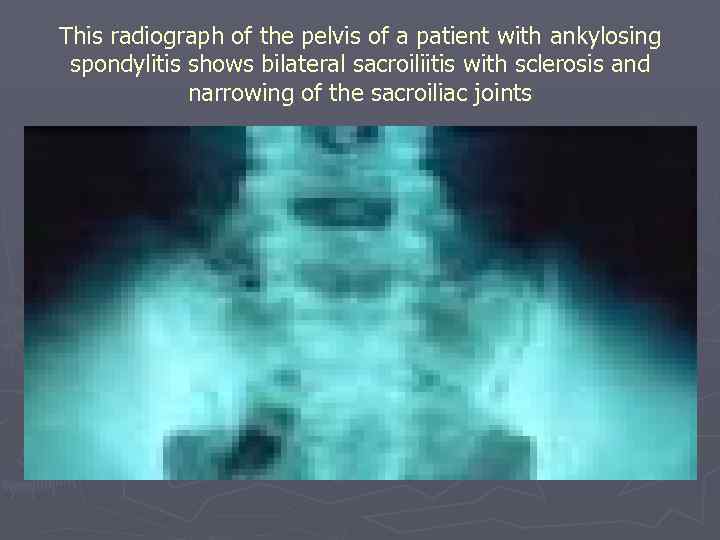 This radiograph of the pelvis of a patient with ankylosing spondylitis shows bilateral sacroiliitis