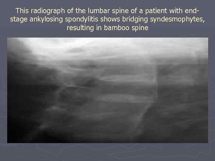 This radiograph of the lumbar spine of a patient with endstage ankylosing spondylitis shows