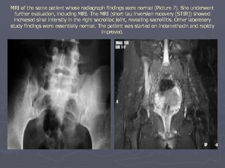 MRI of the same patient whose radiograph findings were normal (Picture 7). She underwent