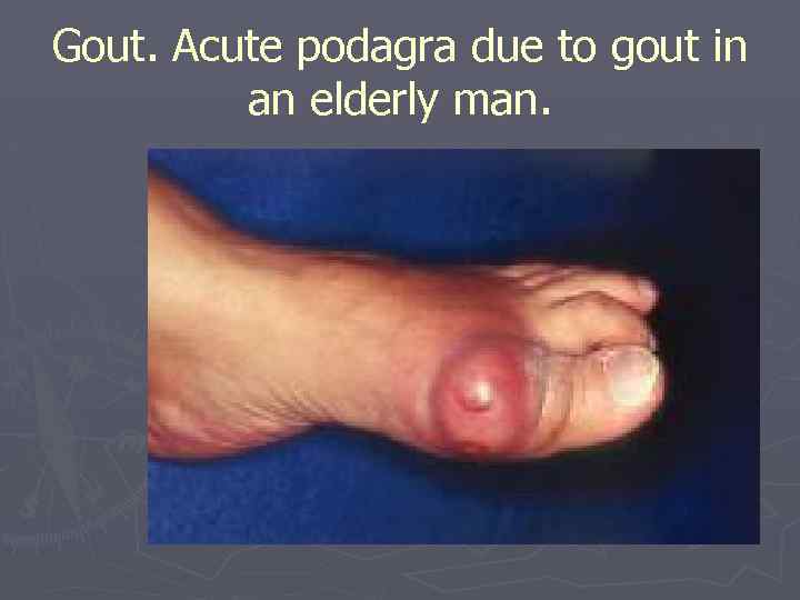 Gout. Acute podagra due to gout in an elderly man. 