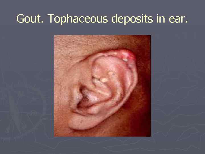Gout. Tophaceous deposits in ear. 