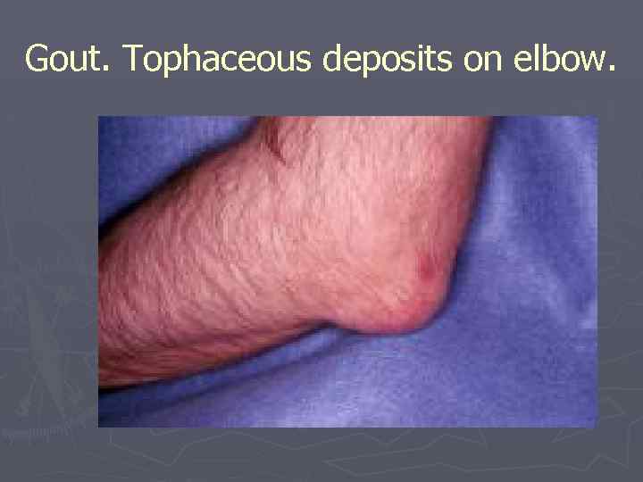 Gout. Tophaceous deposits on elbow. 