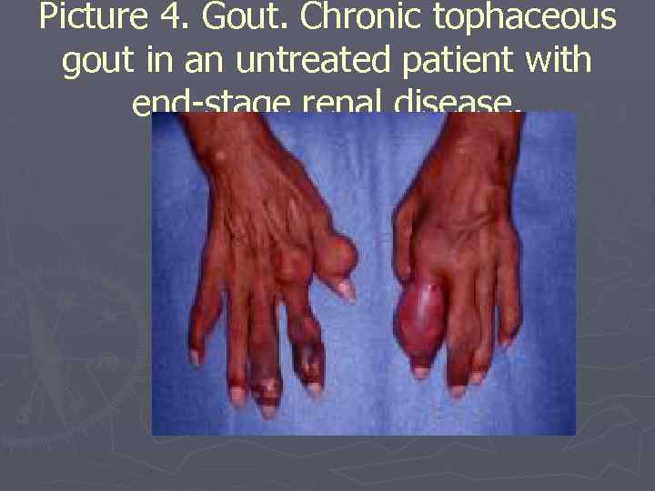 Picture 4. Gout. Chronic tophaceous gout in an untreated patient with end-stage renal disease.