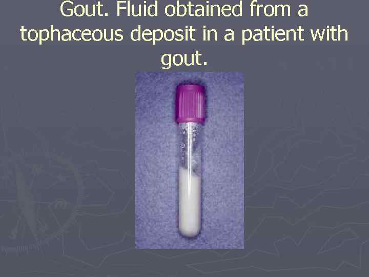 Gout. Fluid obtained from a tophaceous deposit in a patient with gout. 