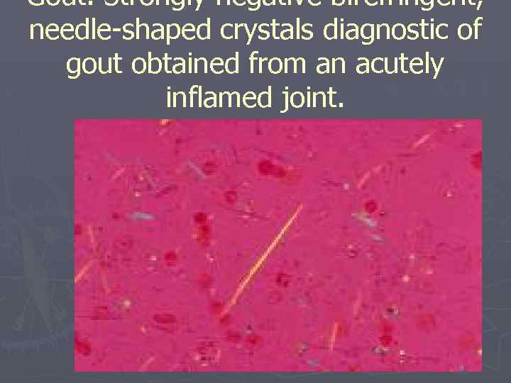 Gout. Strongly negative birefringent, needle-shaped crystals diagnostic of gout obtained from an acutely inflamed