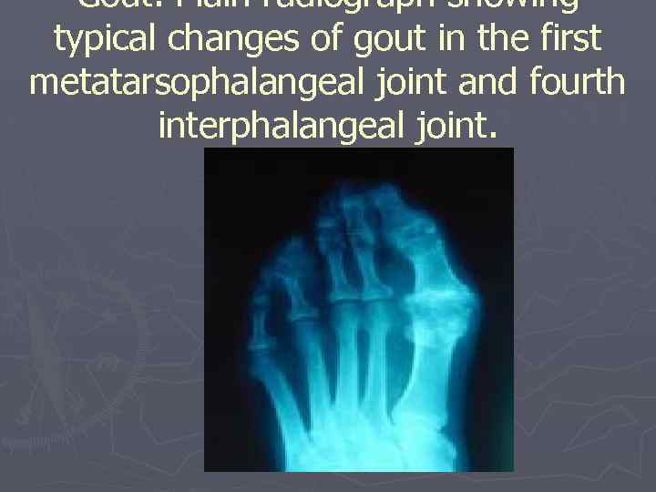 Gout. Plain radiograph showing typical changes of gout in the first metatarsophalangeal joint and