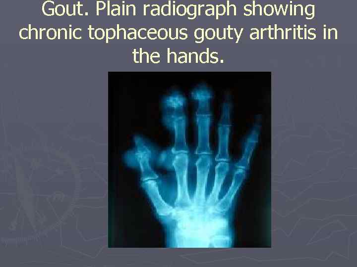 Gout. Plain radiograph showing chronic tophaceous gouty arthritis in the hands. 
