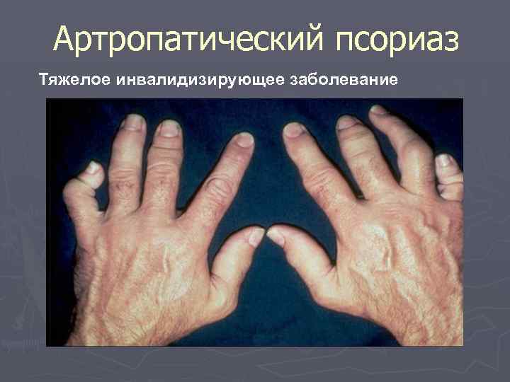 Артропатический псориаз Тяжелое инвалидизирующее заболевание 