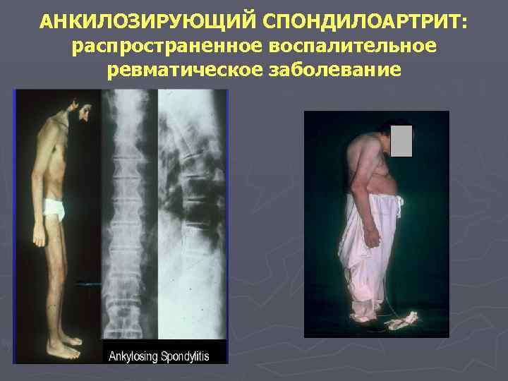 АНКИЛОЗИРУЮЩИЙ СПОНДИЛОАРТРИТ: распространенное воспалительное ревматическое заболевание 