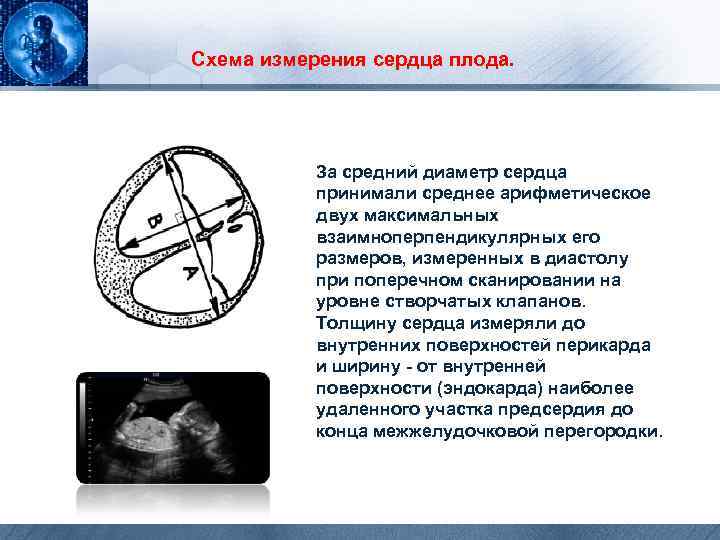 Схема измерения сердца плода. За средний диаметр сердца принимали среднее арифметическое двух максимальных взаимноперпендикулярных
