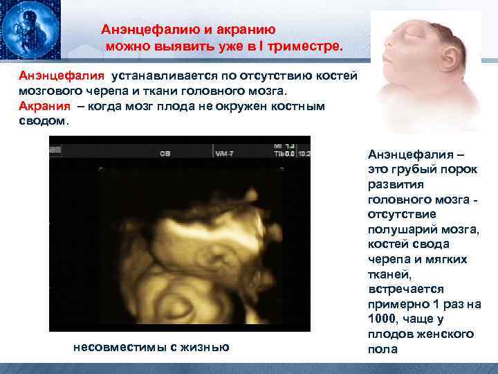 Анэнцефалию и акранию можно выявить уже в I триместре. Анэнцефалия устанавливается по отсутствию костей