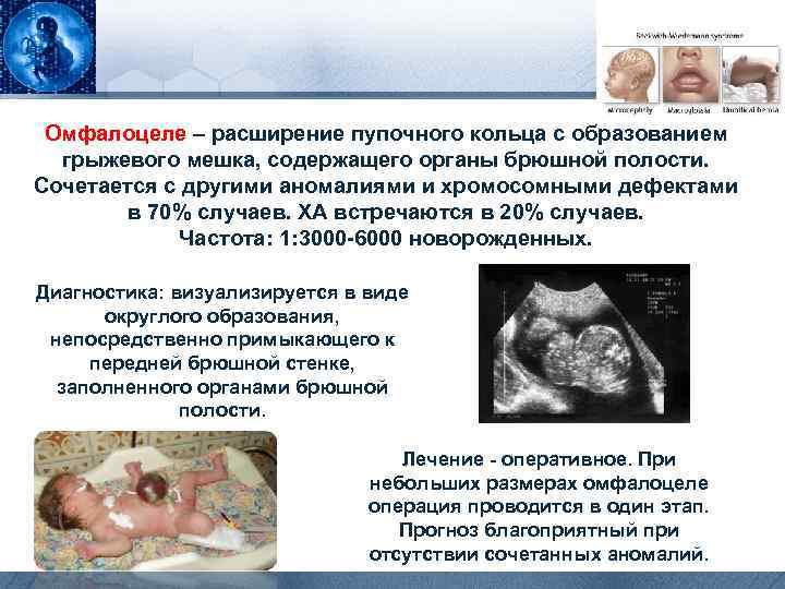 Омфалоцеле – расширение пупочного кольца с образованием грыжевого мешка, содержащего органы брюшной полости. Сочетается