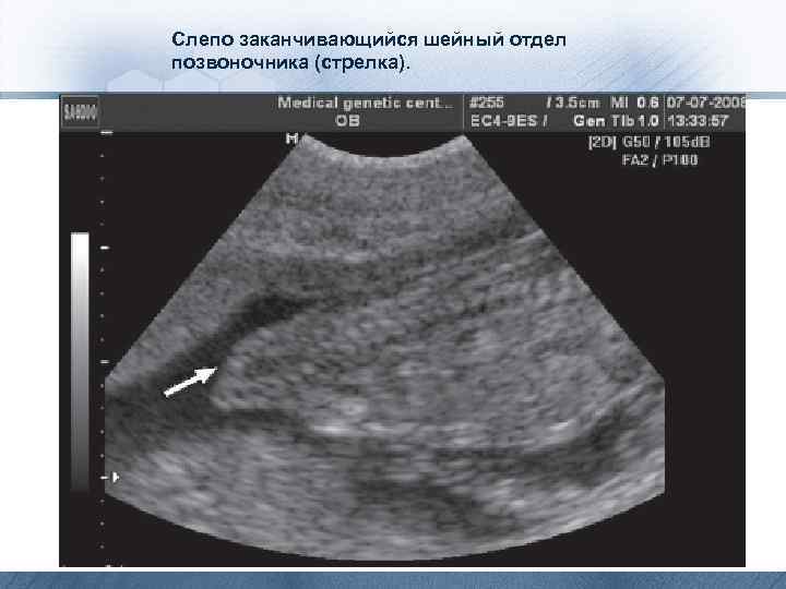 Слепо заканчивающийся шейный отдел позвоночника (стрелка). 