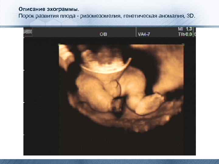 Описание эхограммы. Порок развития плода - ризомелия, генетическая аномалия, 3 D. 