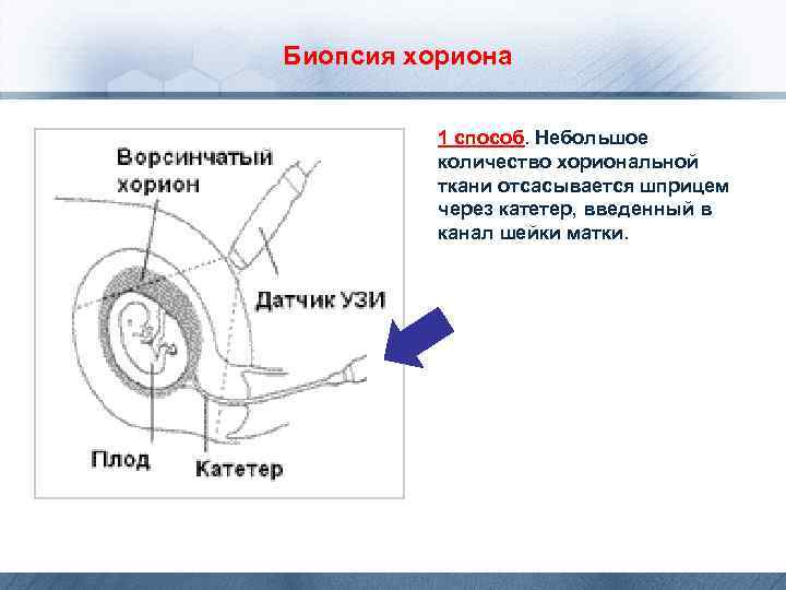 Биопсия хориона 1 способ. Небольшое количество хориональной ткани отсасывается шприцем через катетер, введенный в