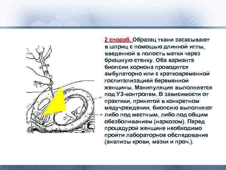2 способ. Образец ткани засасывают в шприц с помощью длинной иглы, введенной в полость