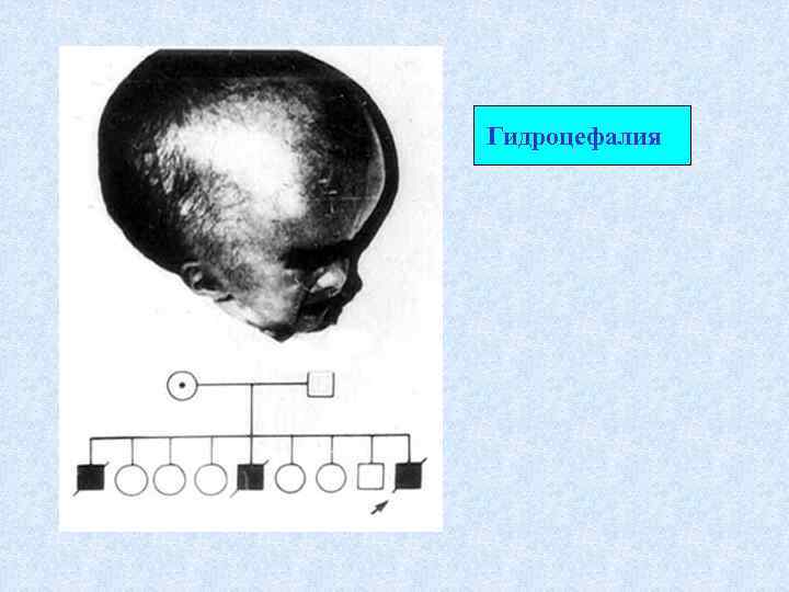 Гидроцефалия 
