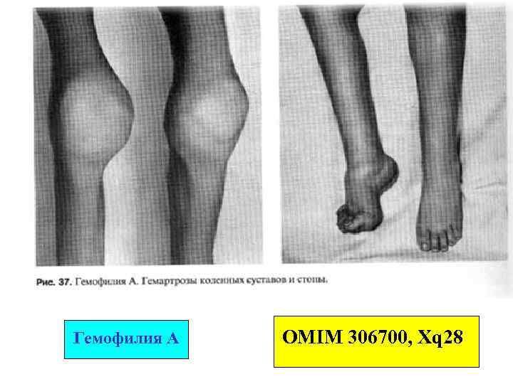 Гемофилия А ОMIM 306700, Xq 28 