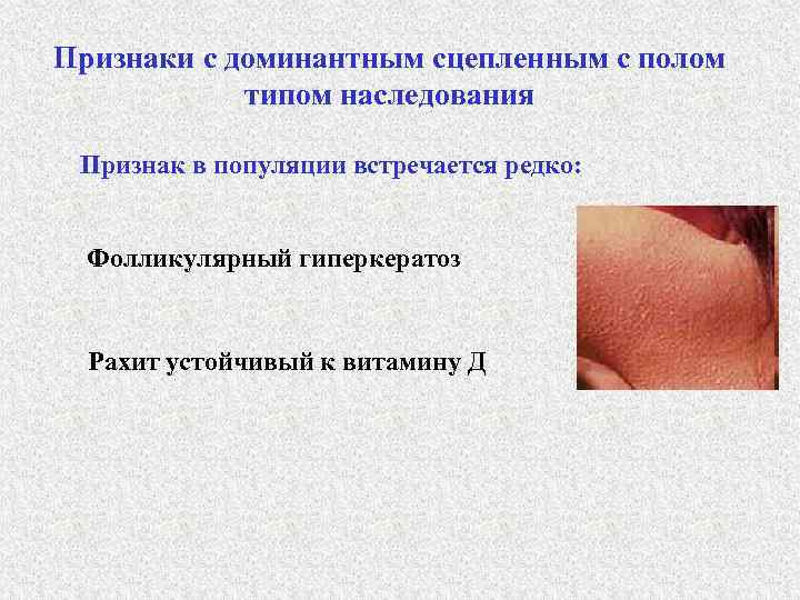 Признаки с доминантным сцепленным с полом типом наследования Признак в популяции встречается редко: Фолликулярный