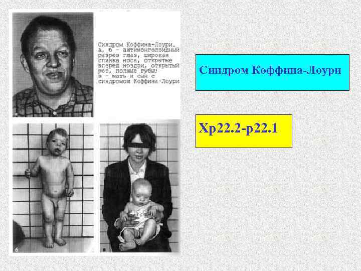 Синдром Коффина-Лоури Xp 22. 2 -p 22. 1 