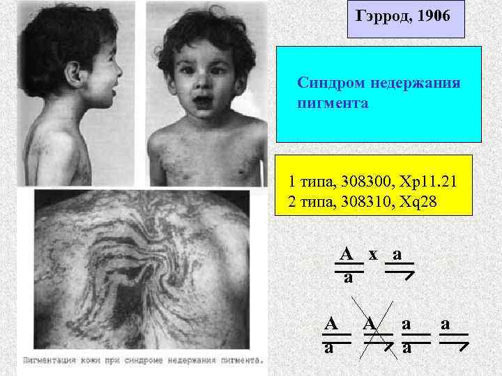 Гэррод, 1906 Синдром недержания пигмента 1 типа, 308300, Хр11. 21 2 типа, 308310, Xq