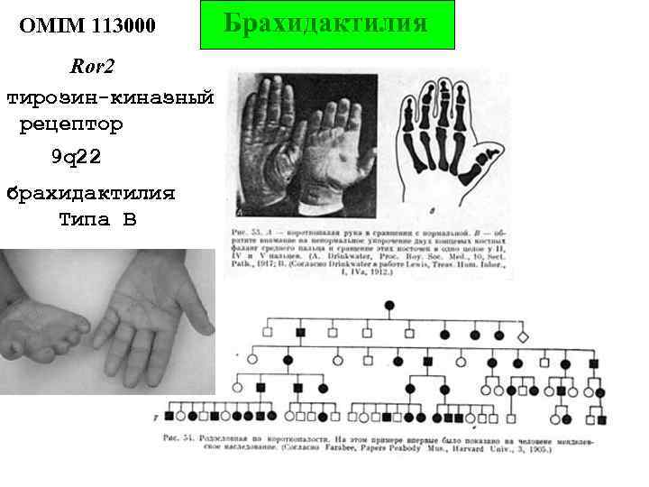 OMIM 113000 Ror 2 тирозин-киназный рецептор 9 q 22 брахидактилия Типа В Брахидактилия 