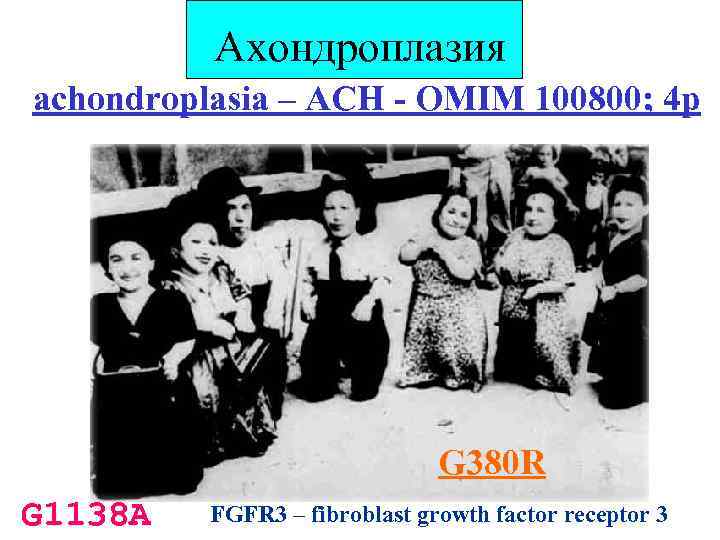Ахондроплазия achondroplasia – ACH - OMIM 100800; 4 p G 380 R G 1138