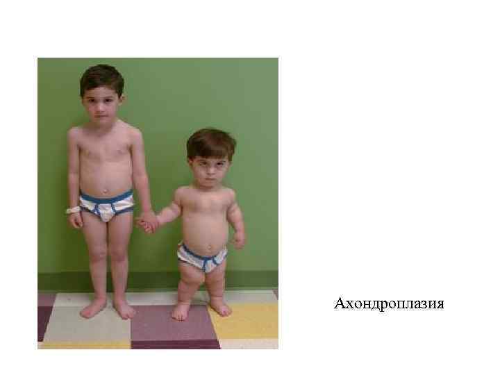 Ахондроплазия 