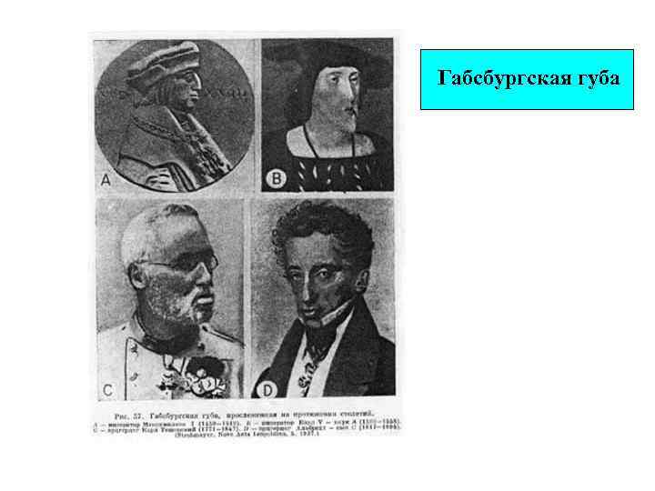 Габсбургская губа 