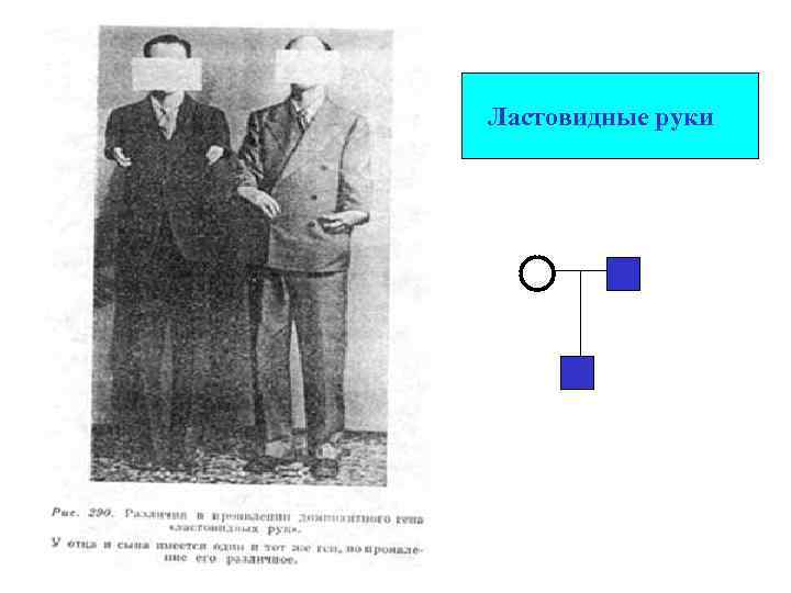 Ластовидные руки 