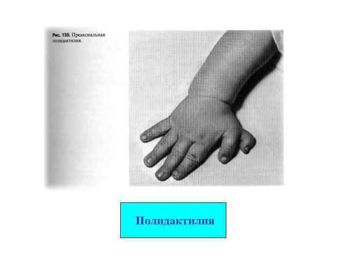 Полидактилия 