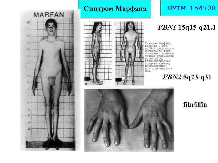 Синдром Марфана ОMIM 154700 FBN 1 15 q 15 -q 21. 1 FBN 2
