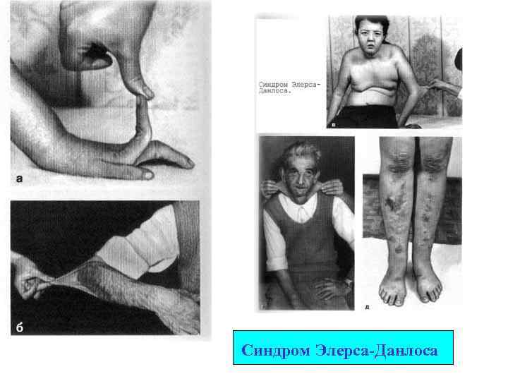Синдром Элерса-Данлоса 