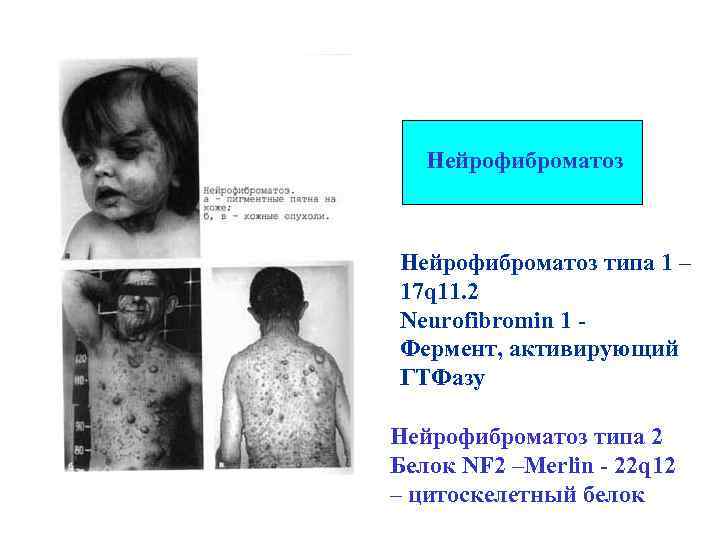 Нейрофиброматоз типа 1 – 17 q 11. 2 Neurofibromin 1 Фермент, активирующий ГТФазу Нейрофиброматоз