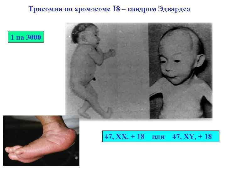 Трисомия по хромосоме 18 – синдром Эдвардса 1 на 3000 47, XX, + 18