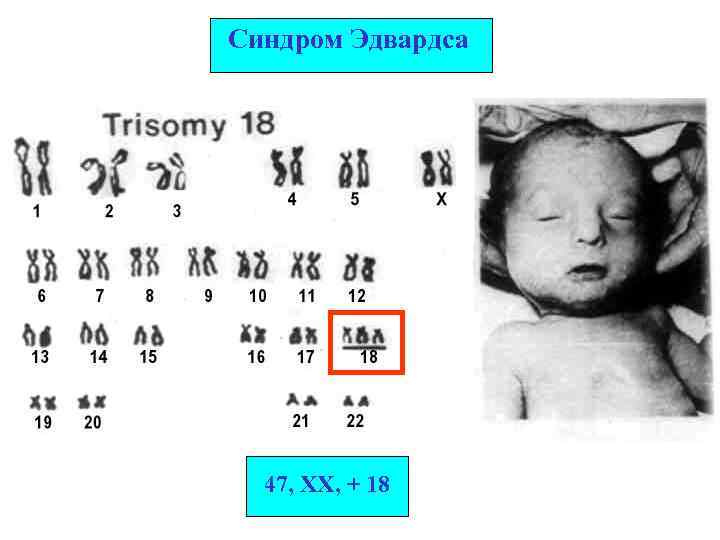 Синдром Эдвардса 47, XX, + 18 