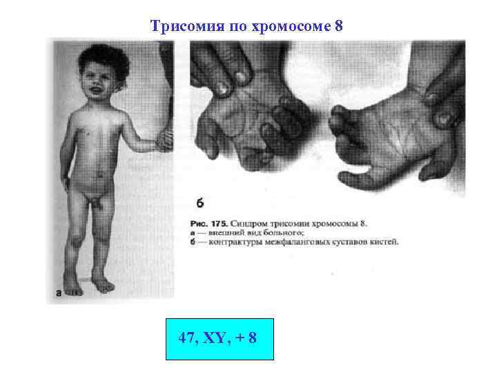 Трисомия по хромосоме 8 47, XY, + 8 