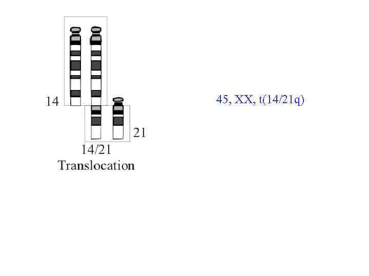 45, ХХ, t(14/21 q) 