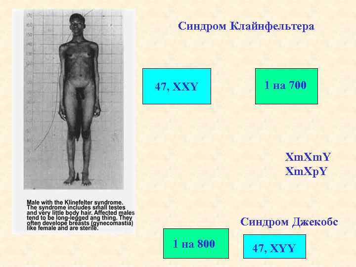 Синдром Клайнфельтера 47, XXY 1 на 700 Xm. Y Xm. Xp. Y Синдром Джекобс