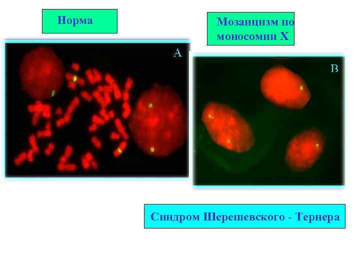 Норма Мозаицизм по моносомии Х Синдром Шерешевского - Тернера 