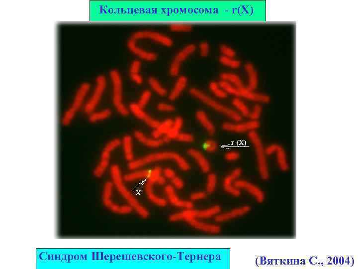 Кольцевая хромосома - r(X) Синдром Шерешевского-Тернера (Вяткина С. , 2004) 
