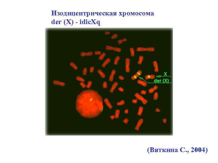 Изодицентрическая хромосома der (X) - idic. Xq (Вяткина С. , 2004) 